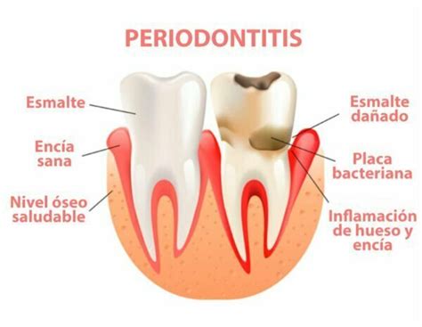 que es la periodontitis